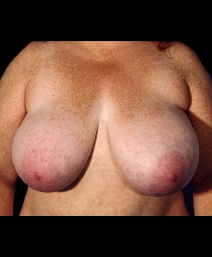 Before Breast Reduction Front Image